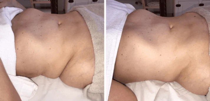 Antes e depois de uma sessão do Método Renata França em Maringá — resultado 1 de 7