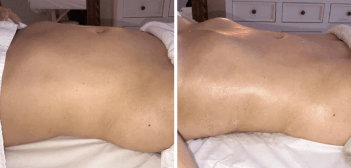 Antes e depois de uma sessão do Método Renata França em Maringá — resultado 2 de 7