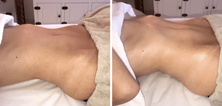 Antes e depois de uma sessão do Método Renata França em Maringá — resultado 3 de 7