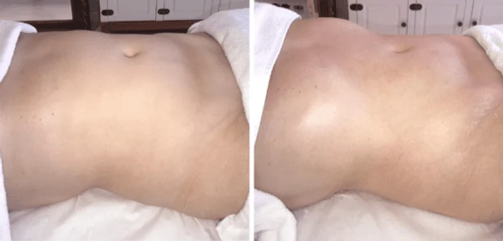 Antes e depois de uma sessão do Método Renata França em Maringá — resultado 4 de 7