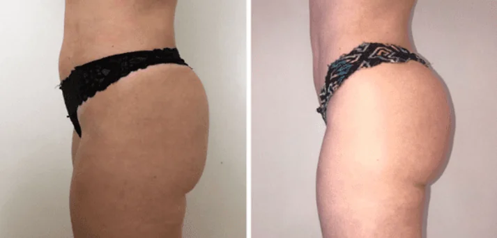 Antes e depois de uma sessão do Método Renata França em Maringá — resultado 5 de 7