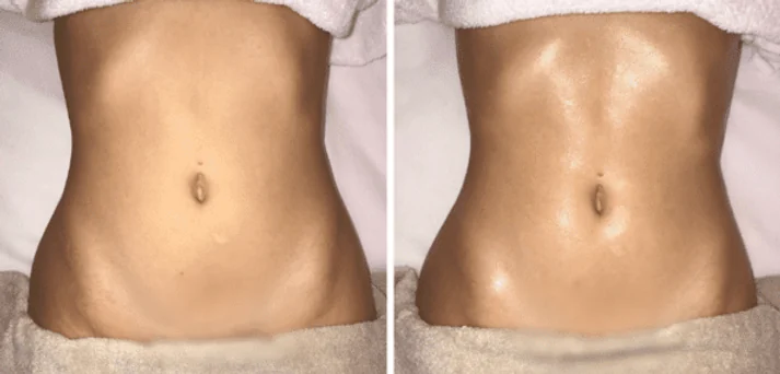 Antes e depois de uma sessão do Método Renata França em Maringá — resultado 6 de 7