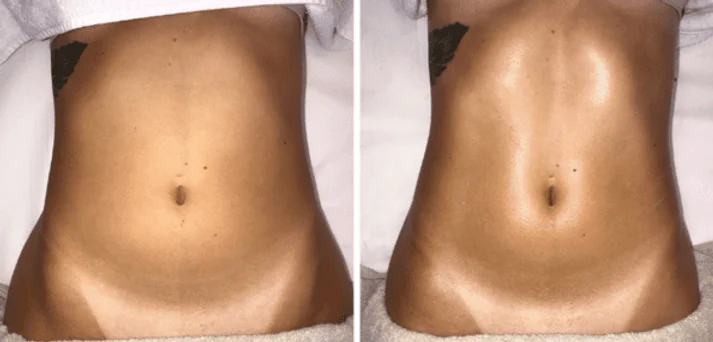 Antes e depois de uma sessão do Método Renata França em Maringá — resultado 7 de 7